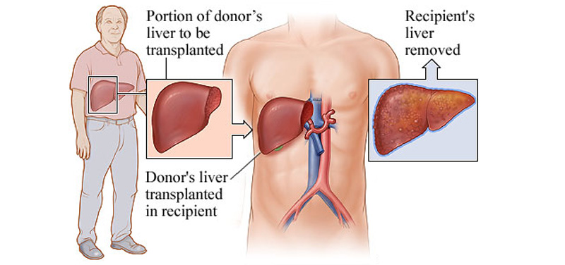 Pan anderson and boob transplant